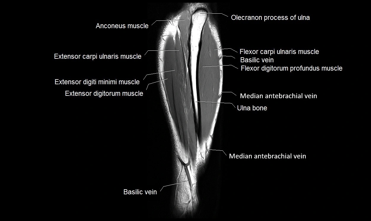 MRI 3T forearm coronal cross sectional anatomy image 23.webp